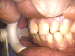 Patient is unhappy with these teeth