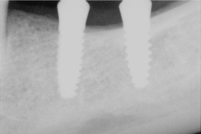 one piece implants in most posterior lower region